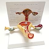 JYKCBP Uterus- Und Ovarialmodell, Weibliches Genitalmodell, Menschliche Gebärmutter Gynäkologische Ovarialpathologie Privatmodell Lehrmittel Für Arztpraxen Educational T